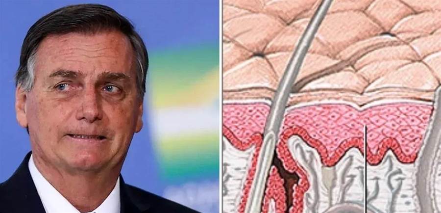 Jair Bolsonaro é diagnosticado com câncer de pele em estágio inicial após cirurgia para remoção de lesões
